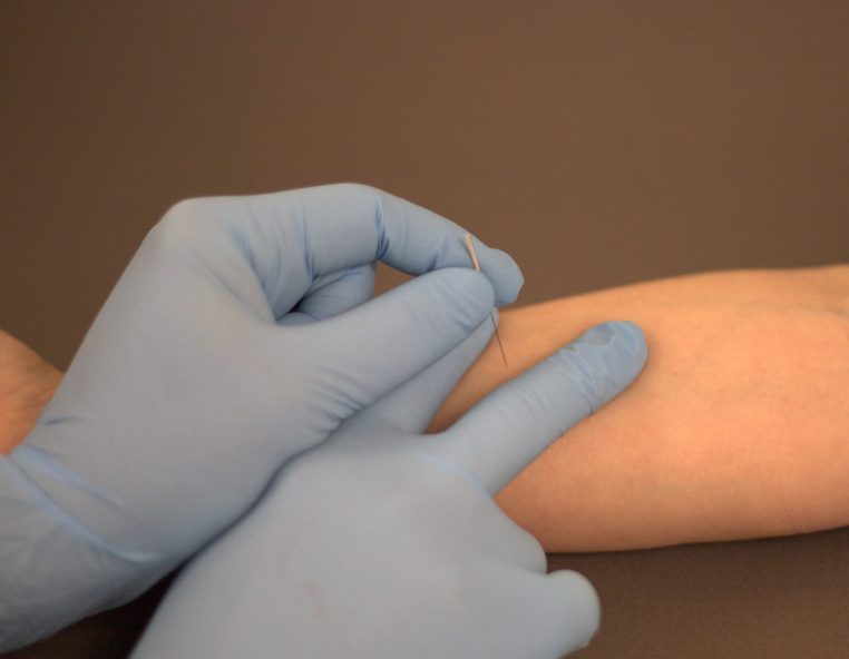 AGUPUNT DRY NEEDLING